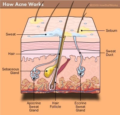 acne-sebum